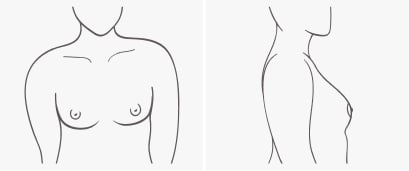 Breast shape Low profile
