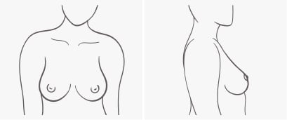 Breast shape Teardrop